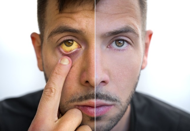 Aumento de 50% nos casos de hepatite A no Rio de Janeiro em 2025